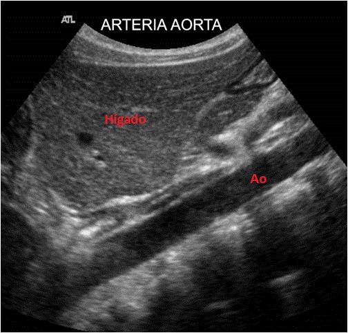 Vena Cava Inferior – Ecografía Fácil