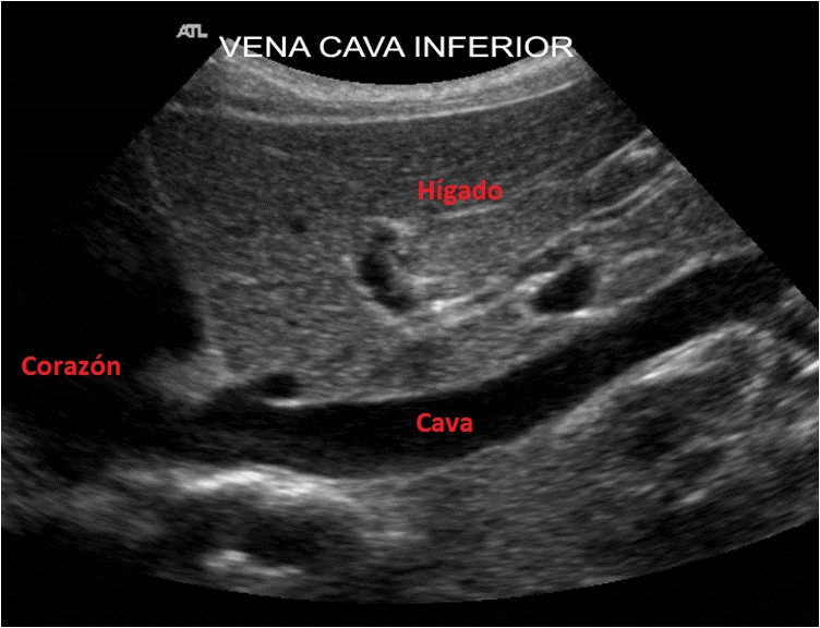 Vena Cava Inferior – Ecografía Fácil