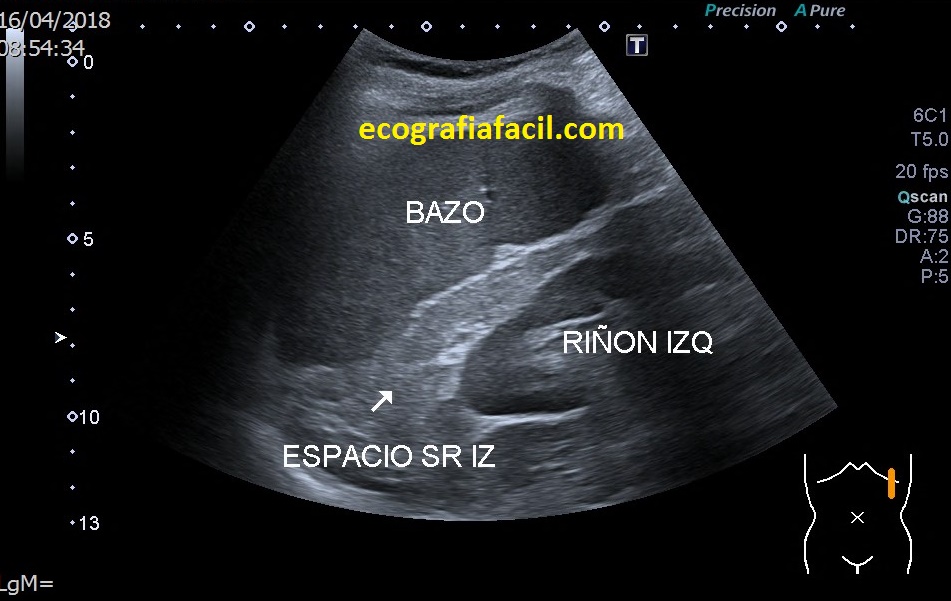 54. Protocolo de Abdomen. El Riñón Izquierdo. – Ecografía Fácil