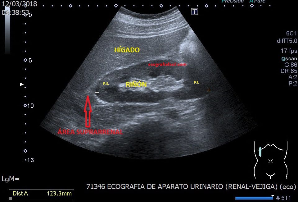 51. Protocolo de Abdomen. Riñón Derecho. – Ecografía Fácil
