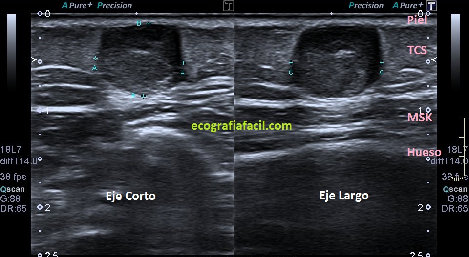 pilomatrixoma-ecograf-a-f-cil