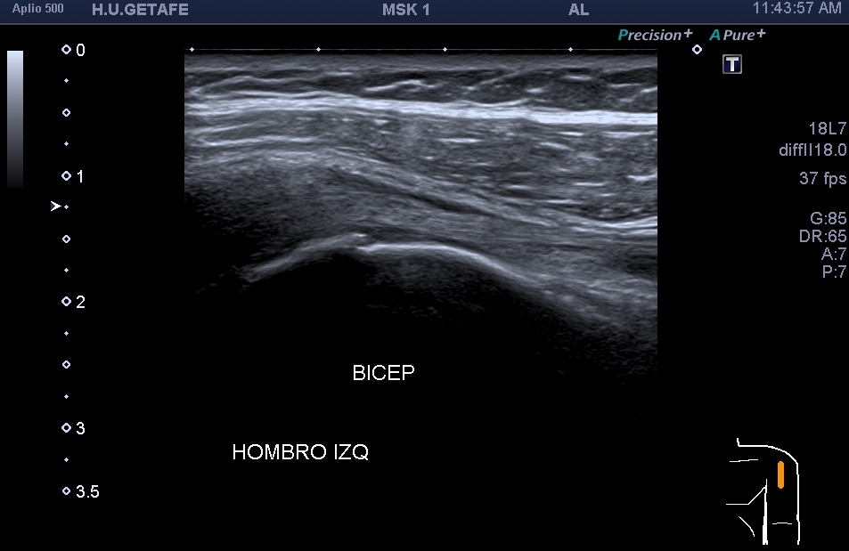 275-tend-n-del-b-ceps-cabeza-corta-y-cabeza-larga-ecograf-a-f-cil