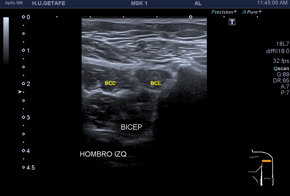 275-tend-n-del-b-ceps-cabeza-corta-y-cabeza-larga-ecograf-a-f-cil