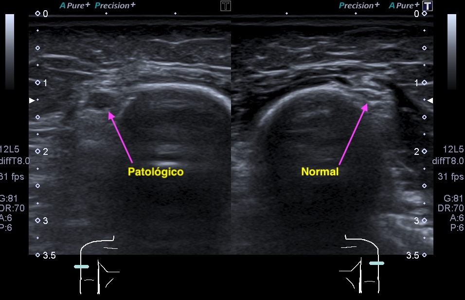 Normal y Patológica1