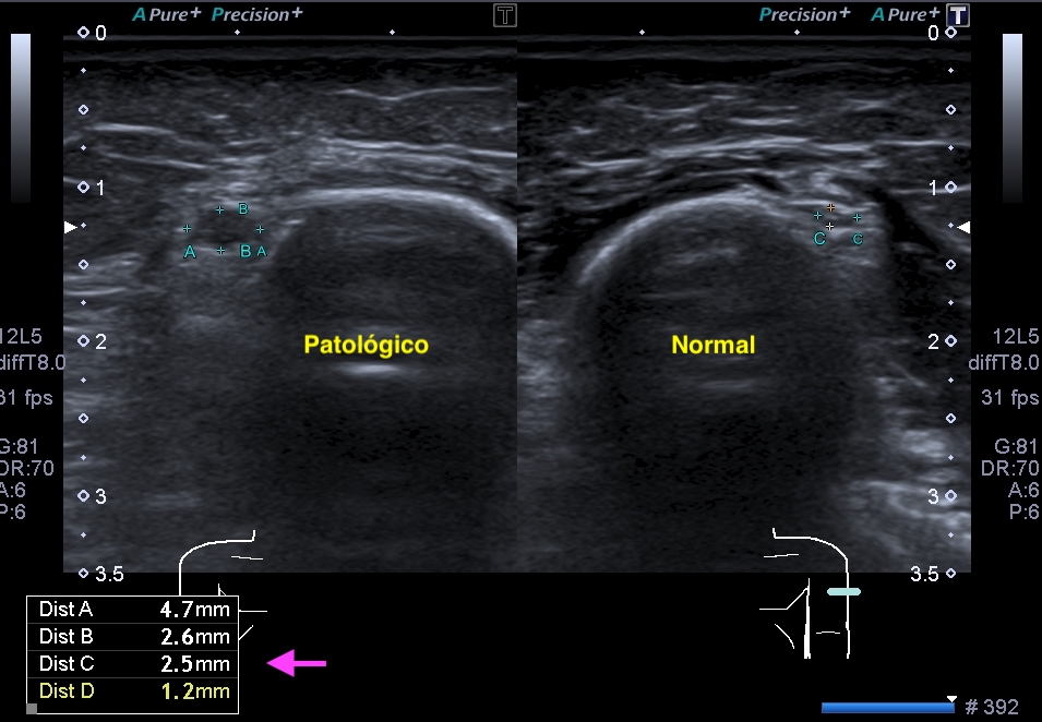 Normal y patológico trans