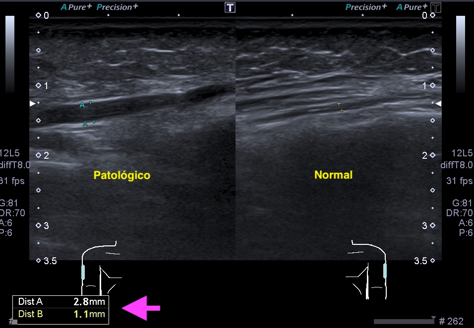 Normal y patológico