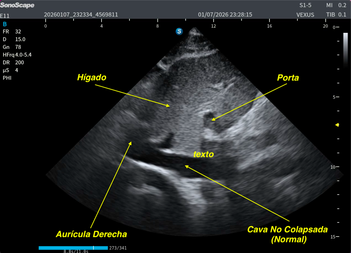 462. Maniobra de SNIFF en POCUS. – Ecografía Fácil